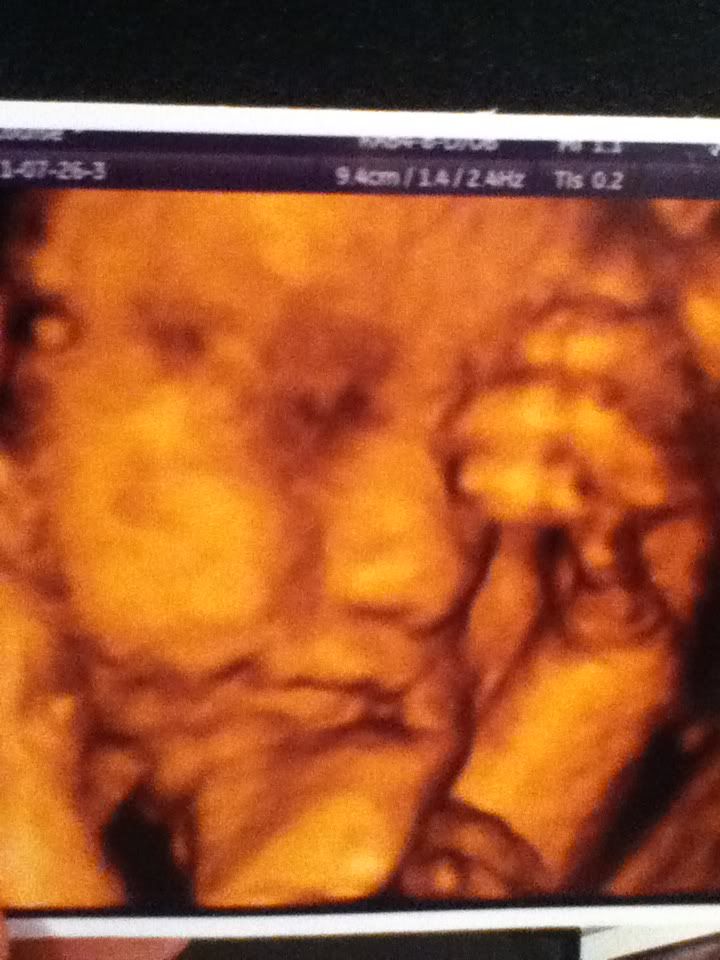 Anyone have 3D scan when pregnant? Pic post! BabyCentre